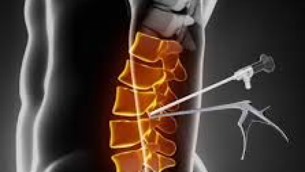 Understanding UBE (Unilateral Biportal Endoscopy): A Game-Changer in Spine Surgery